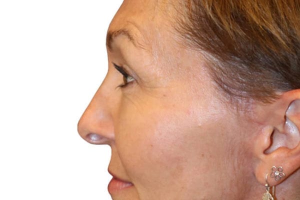 Facelift Patient 14 - After - 1 Carousel Thumbnail