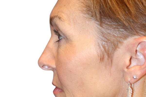 Facelift Patient 14 - Before - 1 Carousel Thumbnail