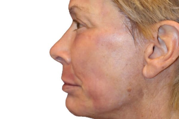 Neck Lift Patient 16 - After - 1 Carousel Thumbnail