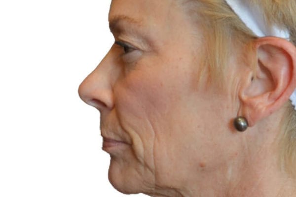 Neck Lift Patient 16 - Before - 1 Carousel Thumbnail
