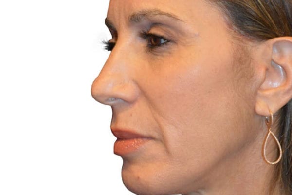 Facelift Patient 02 - After - 1 Carousel Thumbnail