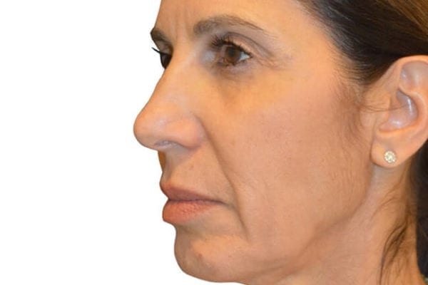 Facelift Patient 02 - Before - 1 Carousel Thumbnail