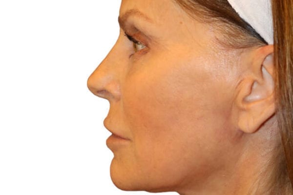 Facelift Patient 03 - After - 1 Carousel Thumbnail
