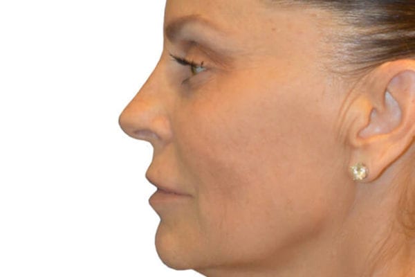 Facelift Patient 03 - Before - 1 Carousel Thumbnail