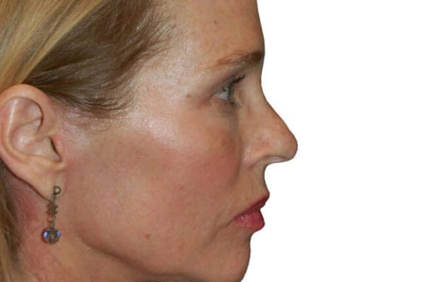 Facelift Patient 04 - After - 1 Carousel Thumbnail