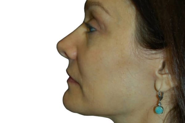 Facelift Patient 07 - After - 1 Carousel Thumbnail