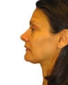 Facelift Patient 07 - Before - 1 thumbnail