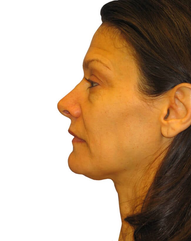 Facelift Patient 07 - Before - 1