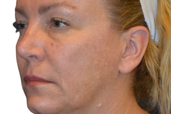 Facelift Patient 08 - Before - 1 Carousel Thumbnail