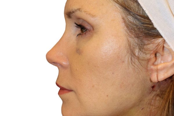 Facelift Patient 09 - After - 1 Carousel Thumbnail