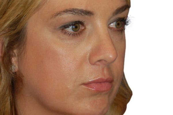 Rhinoplasty Patient 17 - After - 1 Carousel Thumbnail