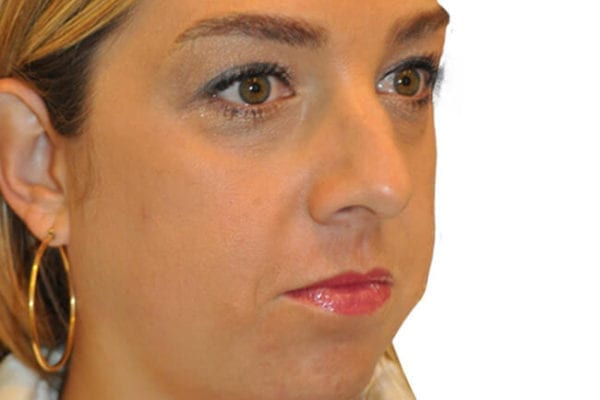 Rhinoplasty Patient 17 - Before - 1 Carousel Thumbnail