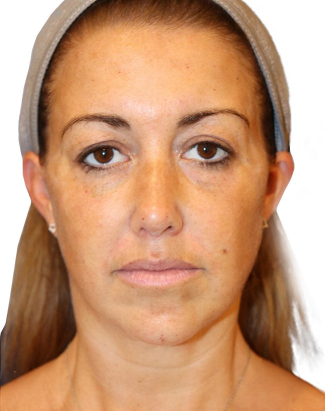 The Diamond Facial Sculpting Patient 25 - After - 2