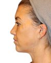 The Diamond Facial Sculpting Patient 25 - After - 1 thumbnail