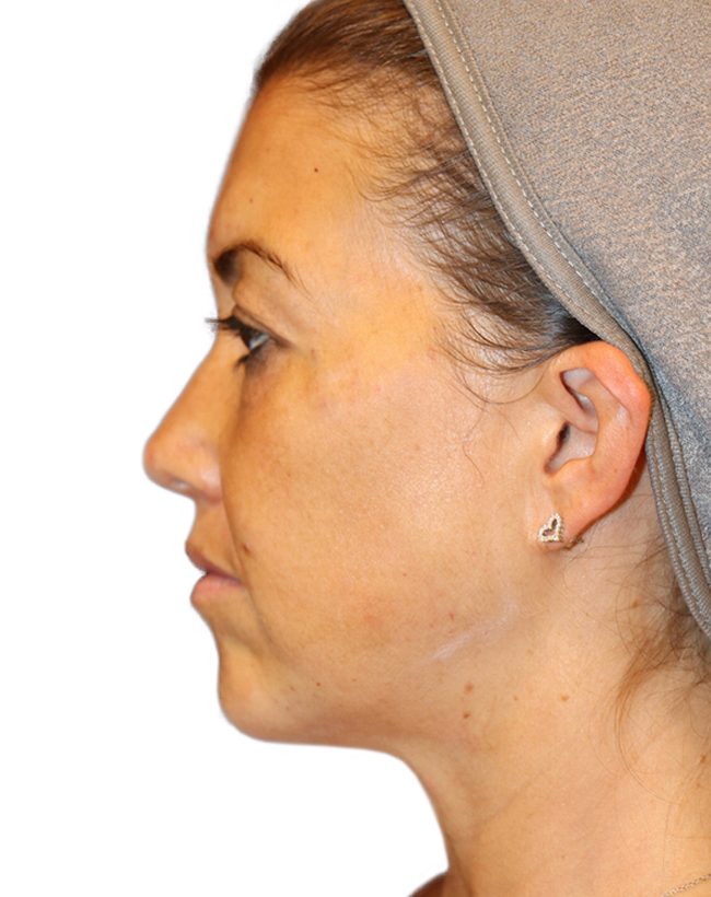 The Diamond Facial Sculpting Patient 25 - After - 3