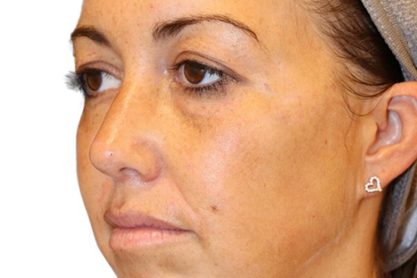 The Diamond Facial Sculpting Patient 25 - After - 1 Carousel Thumbnail