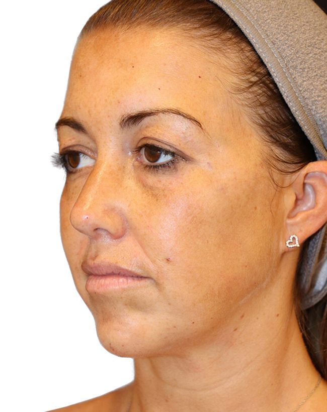 The Diamond Facial Sculpting Patient 25 - After - 1