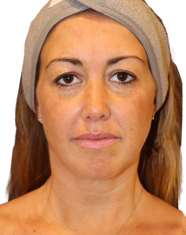 The Diamond Facial Sculpting Patient 25 - Before - 2