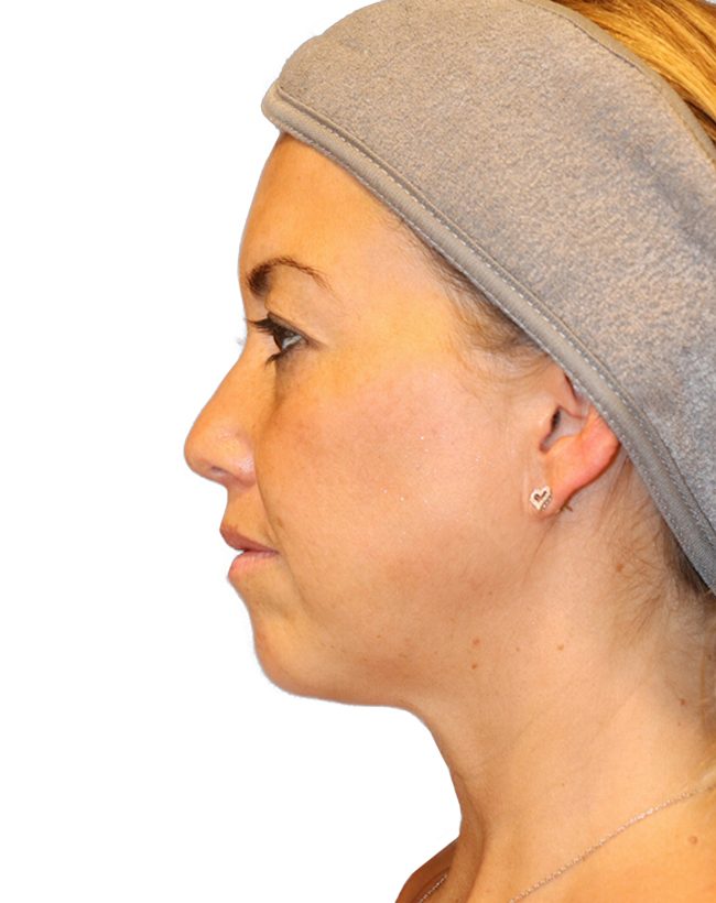 The Diamond Facial Sculpting Patient 25 - Before - 3