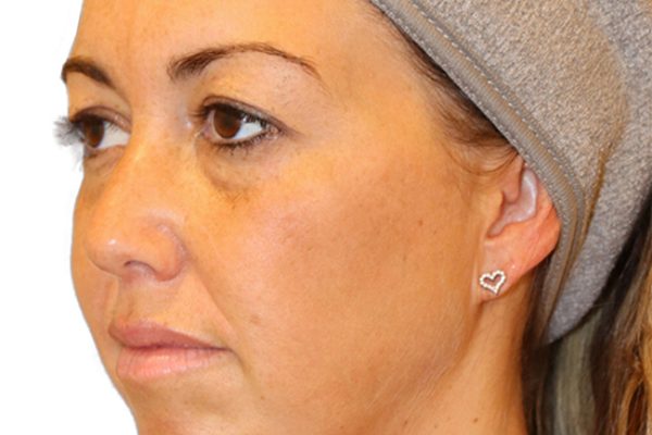 The Diamond Facial Sculpting Patient 25 - Before - 1 Carousel Thumbnail