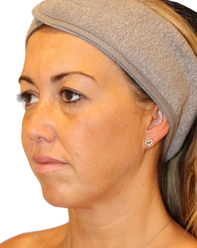 The Diamond Facial Sculpting Patient 25 - Before - 1