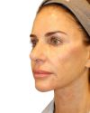 The Diamond Facial Sculpting Patient 26 - After - 1 thumbnail