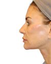 The Diamond Facial Sculpting Patient 26 - After - 1 thumbnail