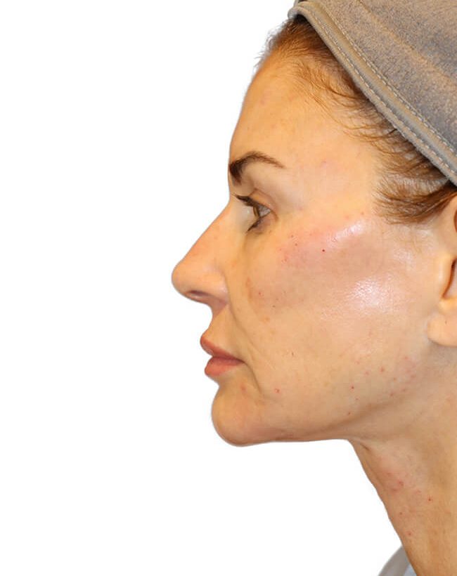 The Diamond Facial Sculpting Patient 26 - After - 2