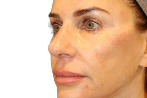 The Diamond Facial Sculpting Patient 26 - After - 1 Carousel Thumbnail