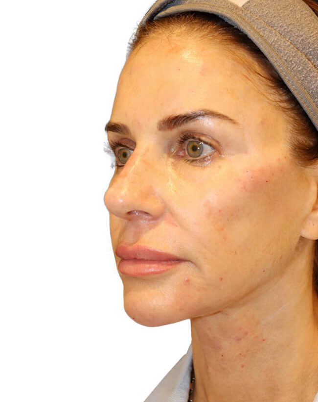 The Diamond Facial Sculpting Patient 26 - After - 1