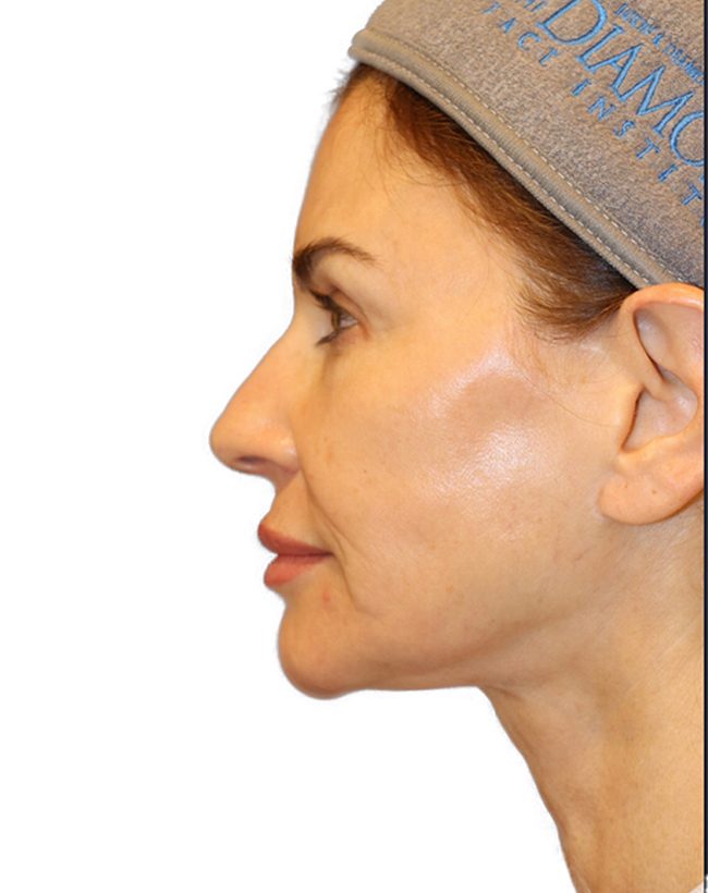 The Diamond Facial Sculpting Patient 26 - Before - 2