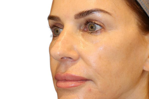 The Diamond Facial Sculpting Patient 26 - Before - 1 Carousel Thumbnail