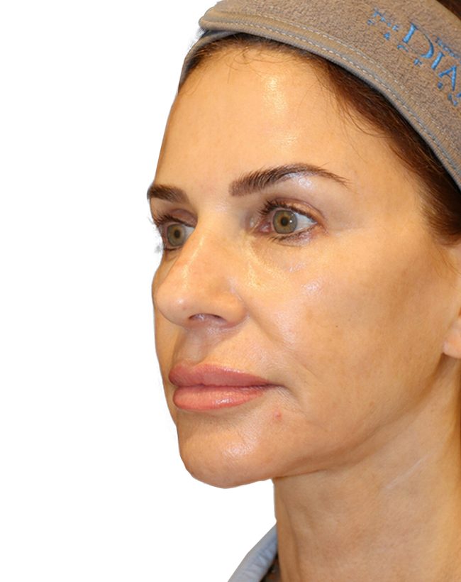 The Diamond Facial Sculpting Patient 26 - Before - 1