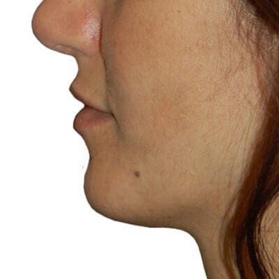 Lip Augmentation Patient 01 - After - 1 Carousel Thumbnail