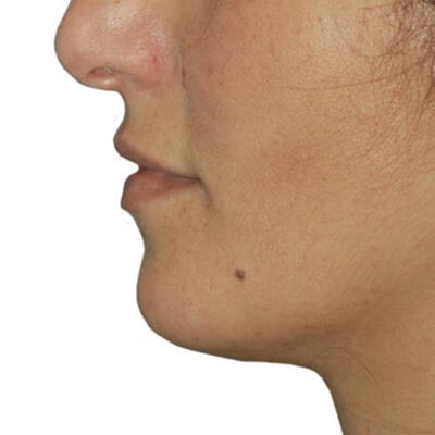 Lip Augmentation Patient 01 - Before - 1 Carousel Thumbnail