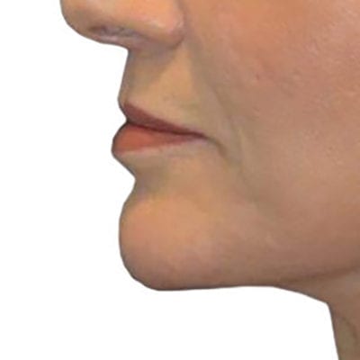 Lip Augmentation Patient 02 - After - 1 Carousel Thumbnail