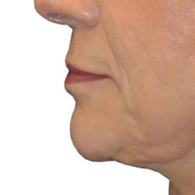 Lip Augmentation Patient 02 - Before - 1 Carousel Thumbnail