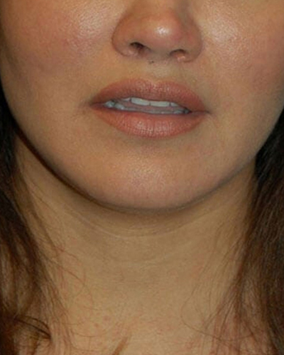 Lip Augmentation Patient 03 - Patient After 1