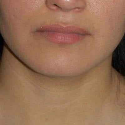 Lip Augmentation Patient 03 - Before - 1 Carousel Thumbnail