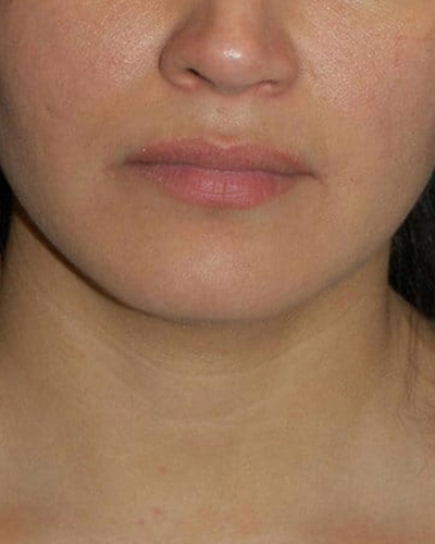 Lip Augmentation Patient 03 - Patient Before 1