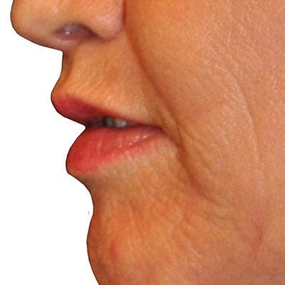 Lip Augmentation Patient 04 - After - 1 Carousel Thumbnail