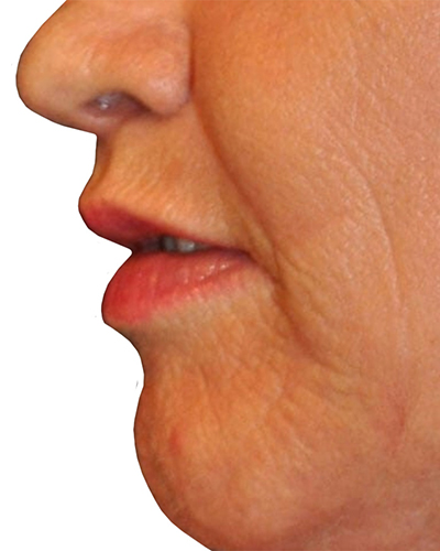 Lip Augmentation Patient 04 - After - 1