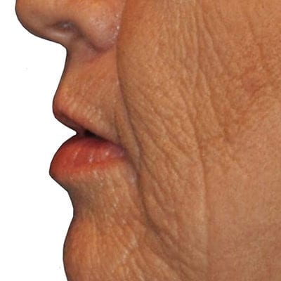 Lip Augmentation Patient 04 - Before - 1 Carousel Thumbnail