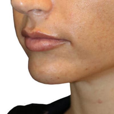 Lip Augmentation Patient 05 - After - 1 Carousel Thumbnail