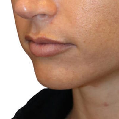 Lip Augmentation Patient 05 - Before - 1 Carousel Thumbnail