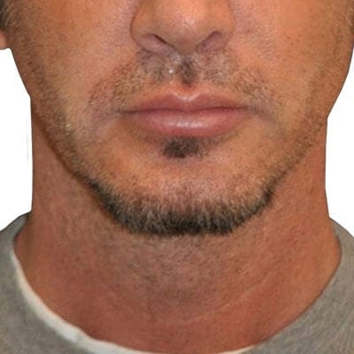 Lip Augmentation Patient 06 - After - 1 Carousel Thumbnail