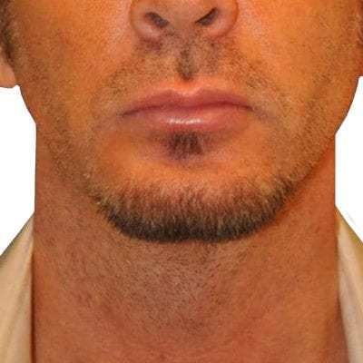 Lip Augmentation Patient 06 - Before - 1 Carousel Thumbnail