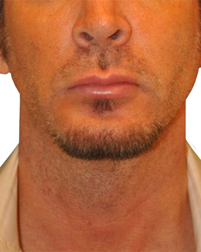 Lip Augmentation Patient 06 - Before - 1