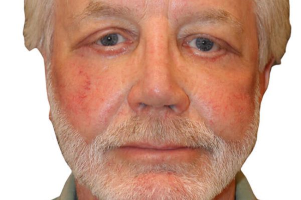 Neck Lift Patient 17 - After - 1 Carousel Thumbnail