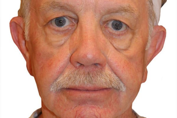 Neck Lift Patient 17 - Before - 1 Carousel Thumbnail